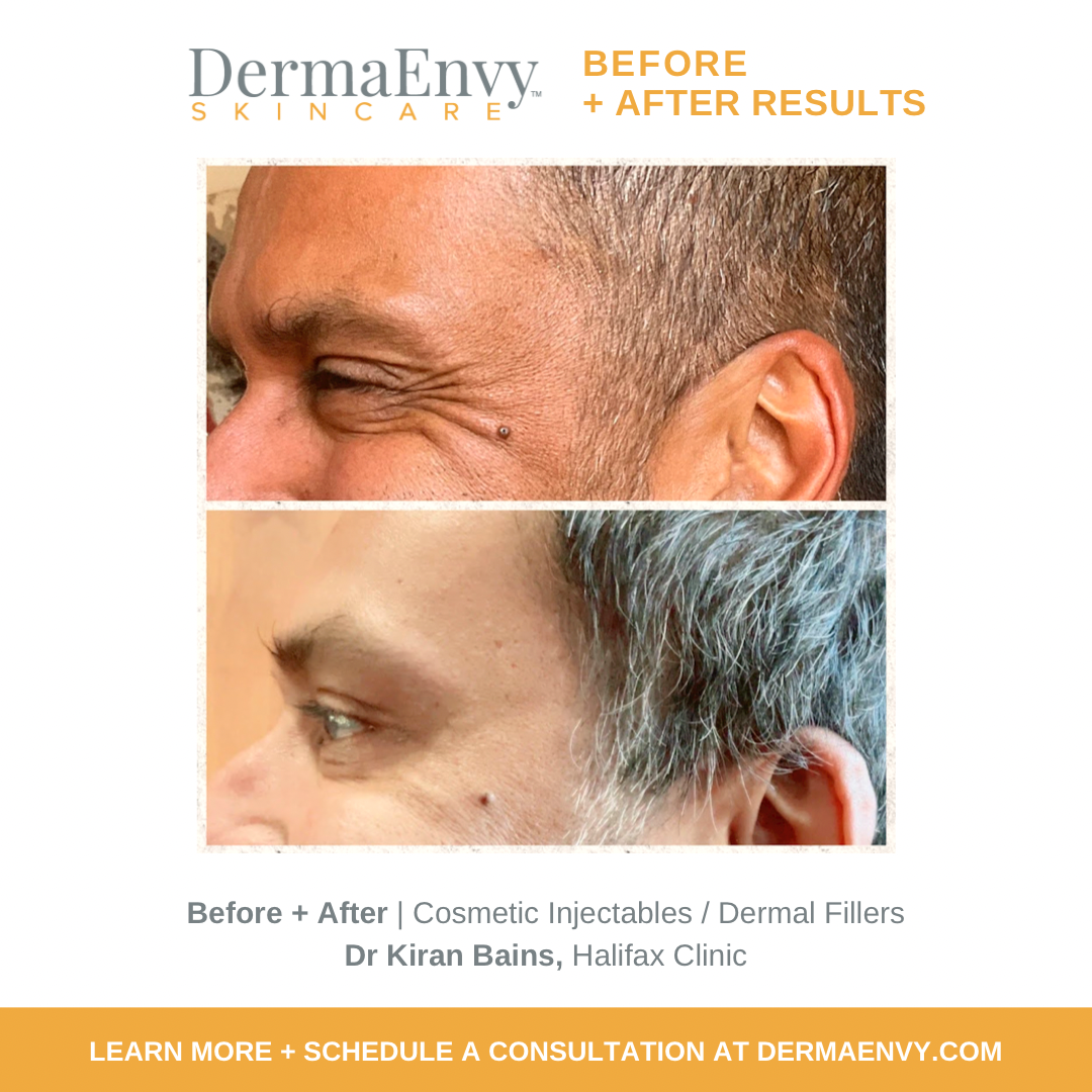 Wrinkle Treatments | Cosmetic Aesthetic Injections | Botox Halifax ...