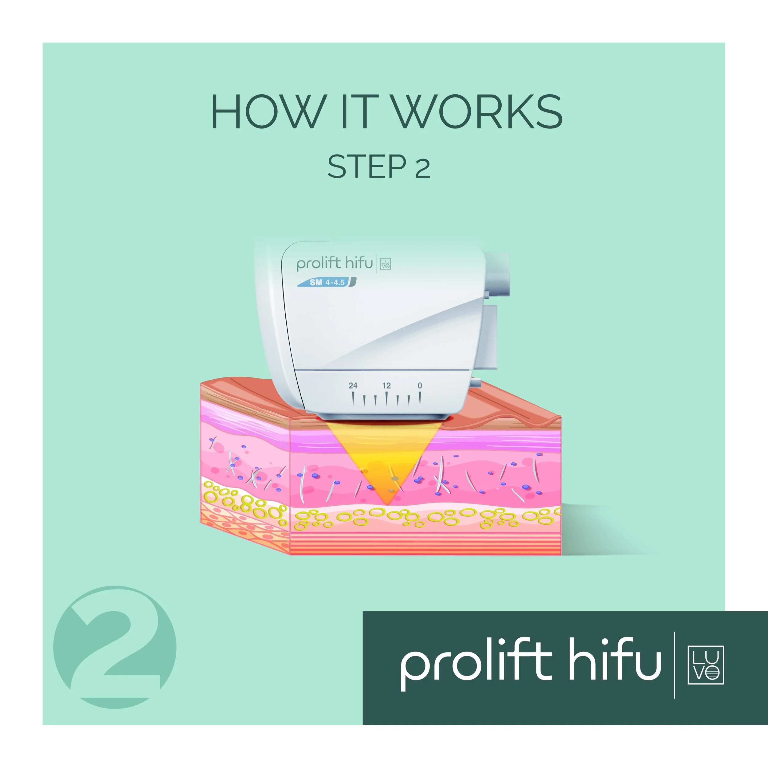 PROLIFT+HIFU_How+It+Works_2.jpg