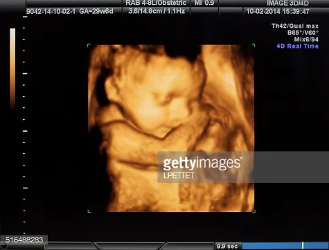NI Baby Scan