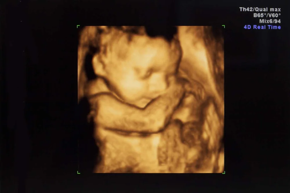 Ni Baby Scan