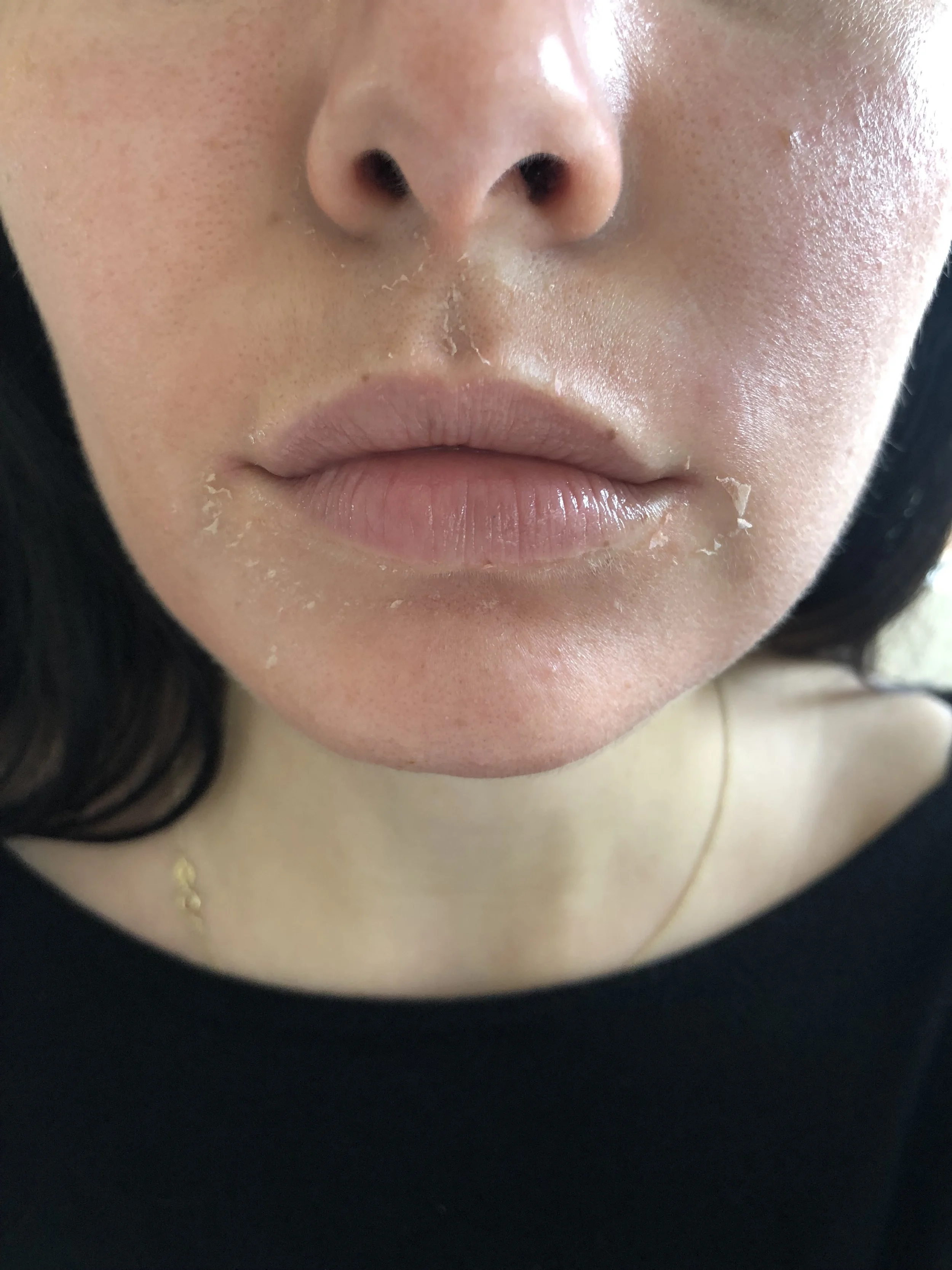 Day 3 Morning - Peeling has started around my mouth and nose.