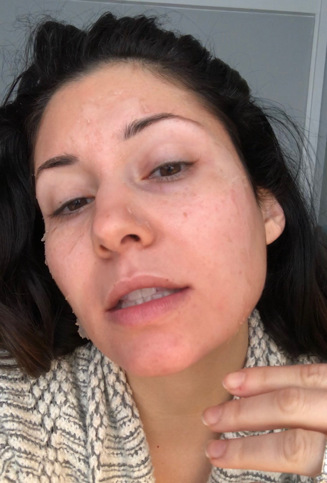 Day 5 - Peeling has extended to my forehead area.