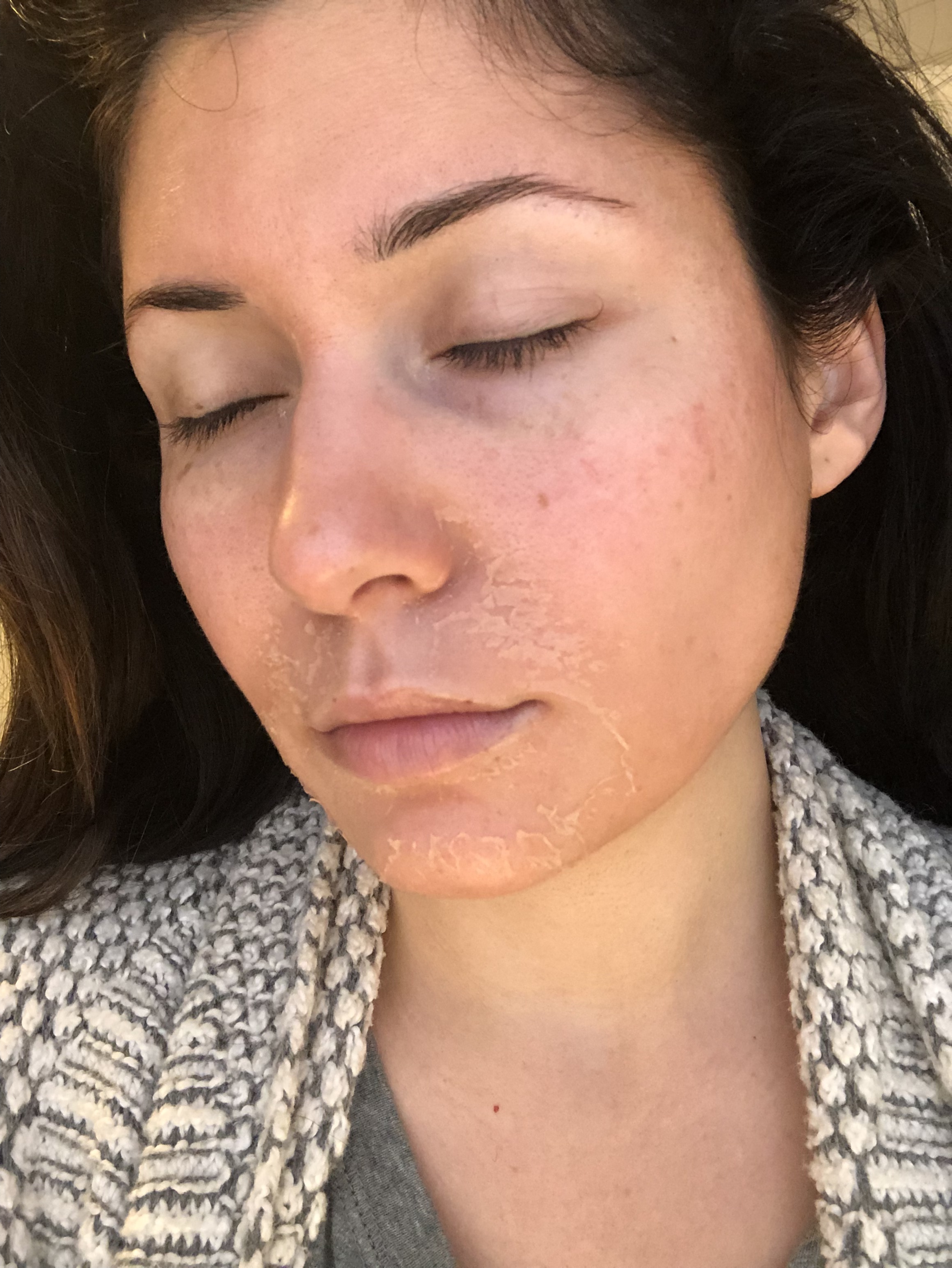 Day 4 - Mouth, nose and then cheek peeling!