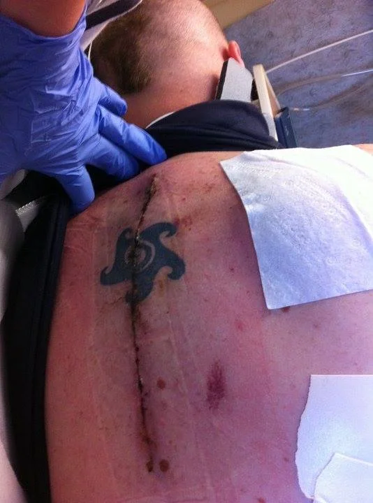 May 9th, 2011 was a day we almost lost Adam. That's Ken Toey 's back as they were changing the dressing.