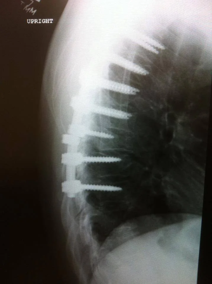 May 9th, 2011 was a day we almost lost Adam. This is Ken Toey's new back.