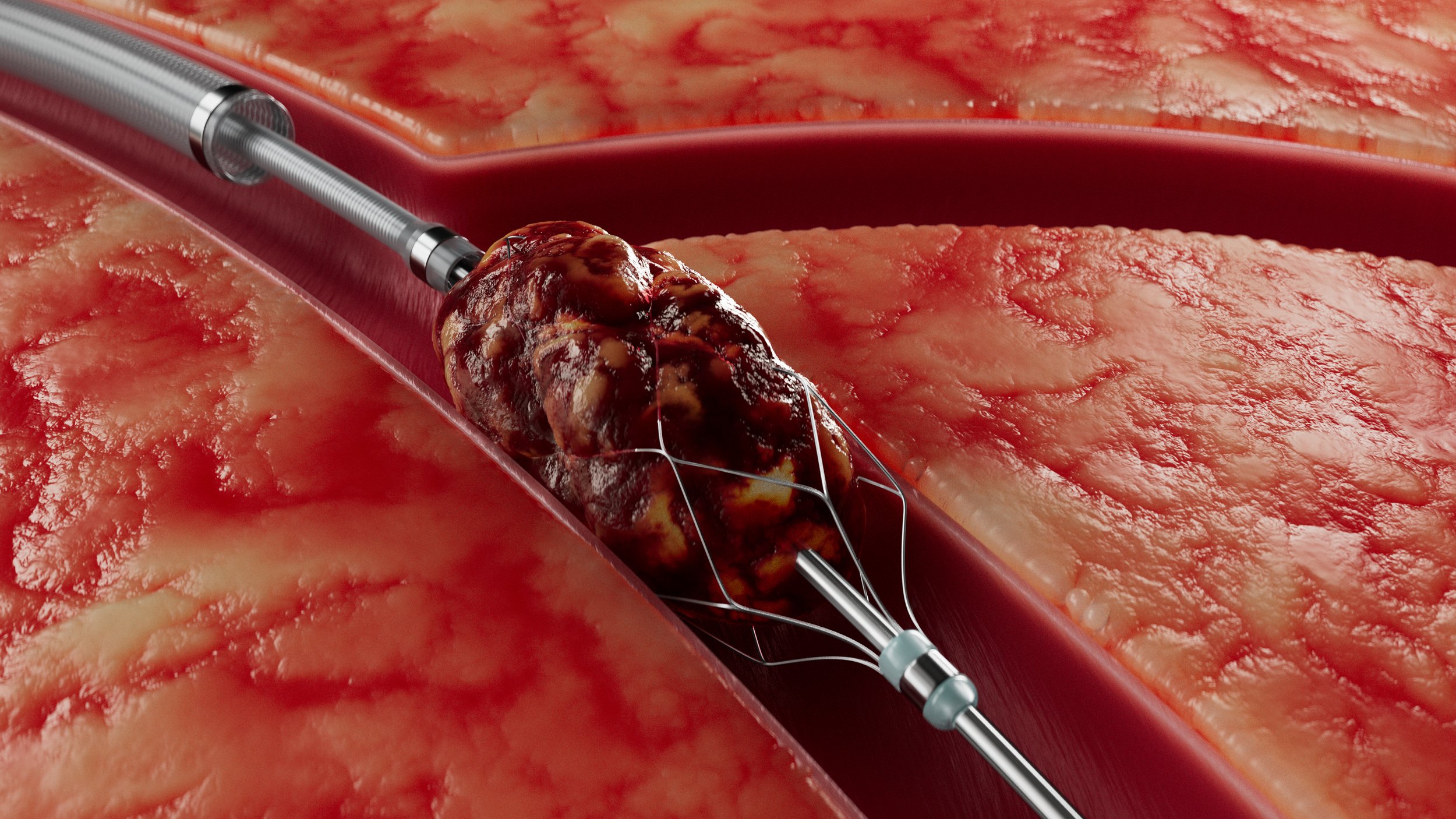 104_Innova_Vein+Snare_Thrombus_v1.jpg