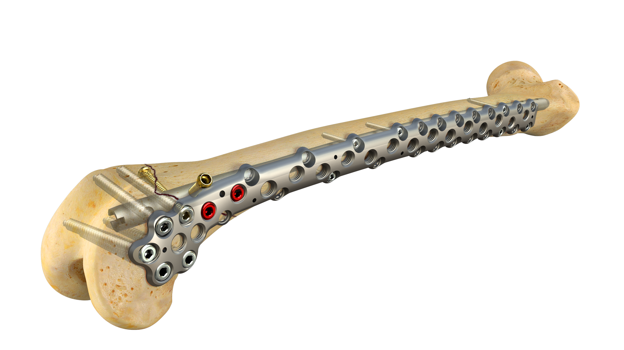 Image4_PlateAndNailPreFracture_Fractured.png