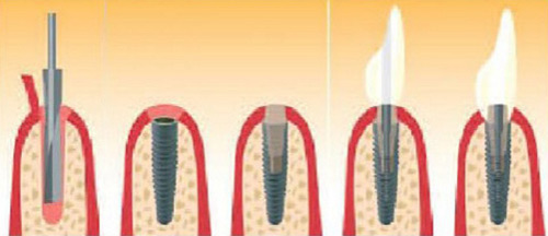 Schaubild Implantatbehandlung