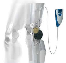 KAFO (Knee-Ankle-Foot Orthoses) conventional and stance control