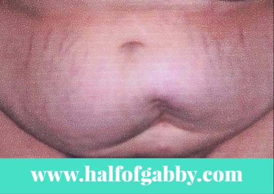 My Ass-Belly before I lost my weight. Sorry for the poor quality. I had to take a picture of a picture. But you can still see the nasty lower abdomen scar that I'm talking about. I hated it!