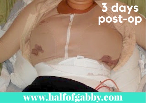 September 19, 2010: This is just home from hospital, 3 days post-op. I was pretty much bleeding everywhere at this point and super swollen. Yikes!