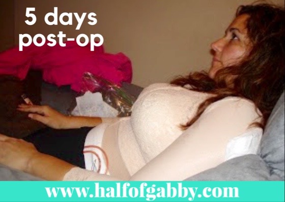 My breasts were very swollen for several months. I kept them bound with a super snug compression bra.