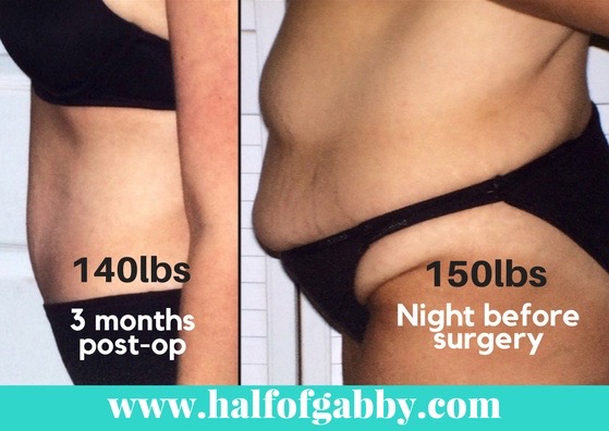 The pic above looks like an incredible difference in weight, but it wasn't at all! Before my surgery, I was 150 pounds (down from 262 pounds). After my surgery, I was 144 pounds. Only a six pound difference! The pic above (on the right) shows a pic of me the night before my body lift surgery. The pic above (on the left) is three months post-op, so I had lost another four pounds once the swelling went down and my body was starting to recover. 