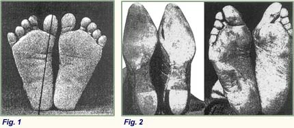How shoes affect your feet (and what to do about it)