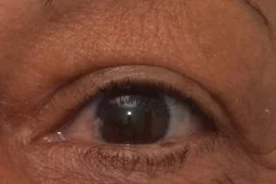 upper eyelid lift blepharoplasty postop.jpg