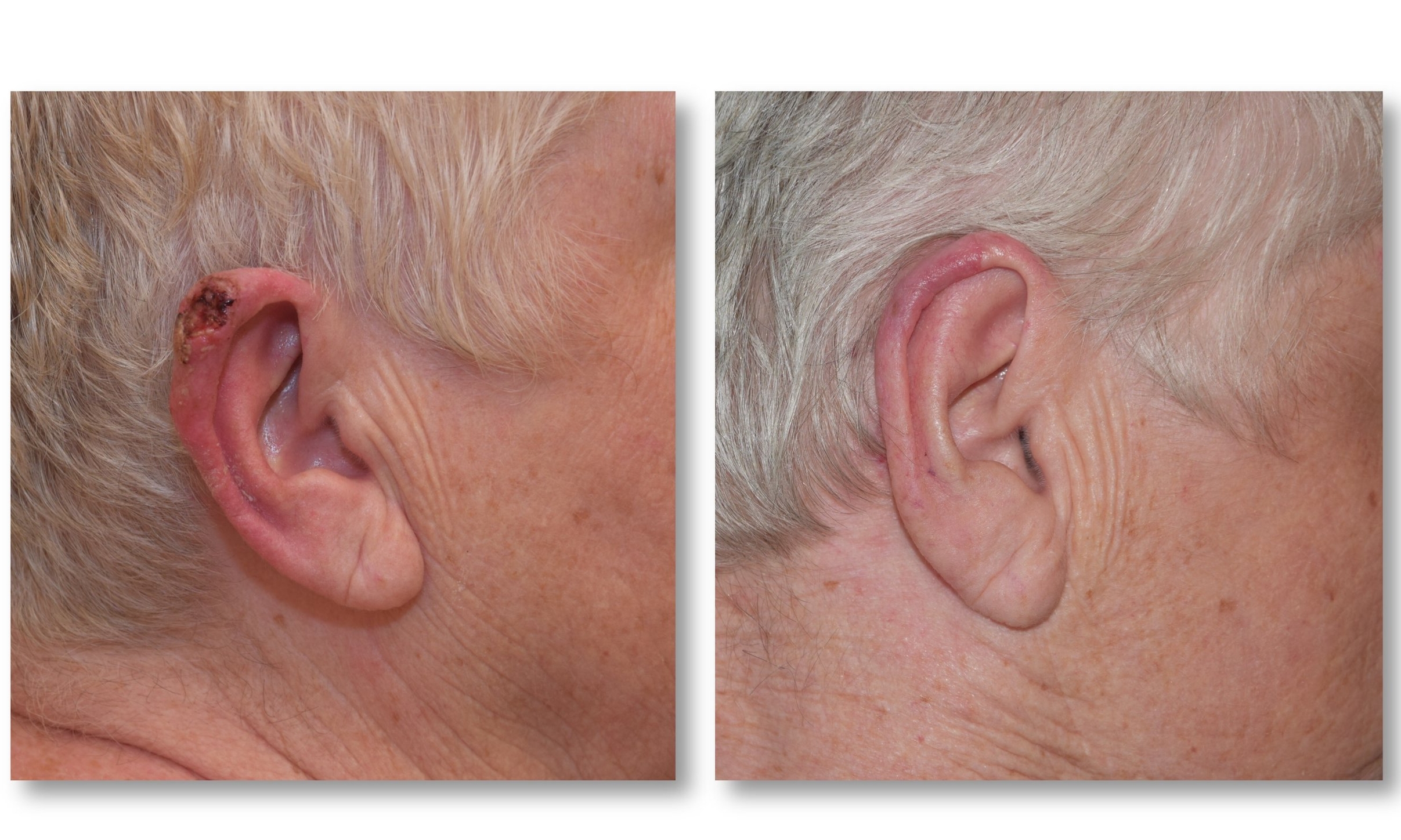 ear reconstruction postauricular flap.jpg