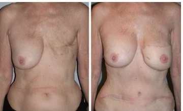 breast reconstruction delayed.jpg