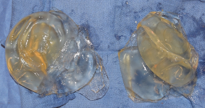 ruptured breast implant exchange.jpg