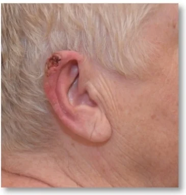 squamous cell carcinoma.jpg