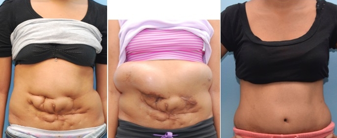 abdominal wall reconstruction tissue expansion.jpg