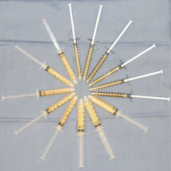 Fat grafting can restore or improve soft tissue volume by gently removing fat from one area of the body and carefully introducing to another area. this image shows fat prepared for transfer to the face and hands for rejuvenation.