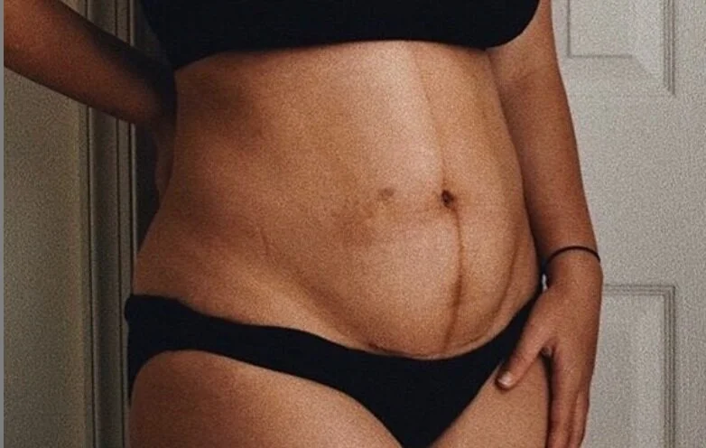 C-Section Scar Massage How-To 