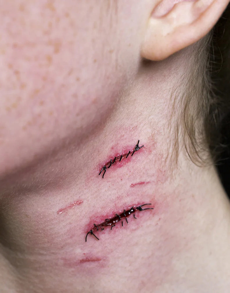 Stitches 