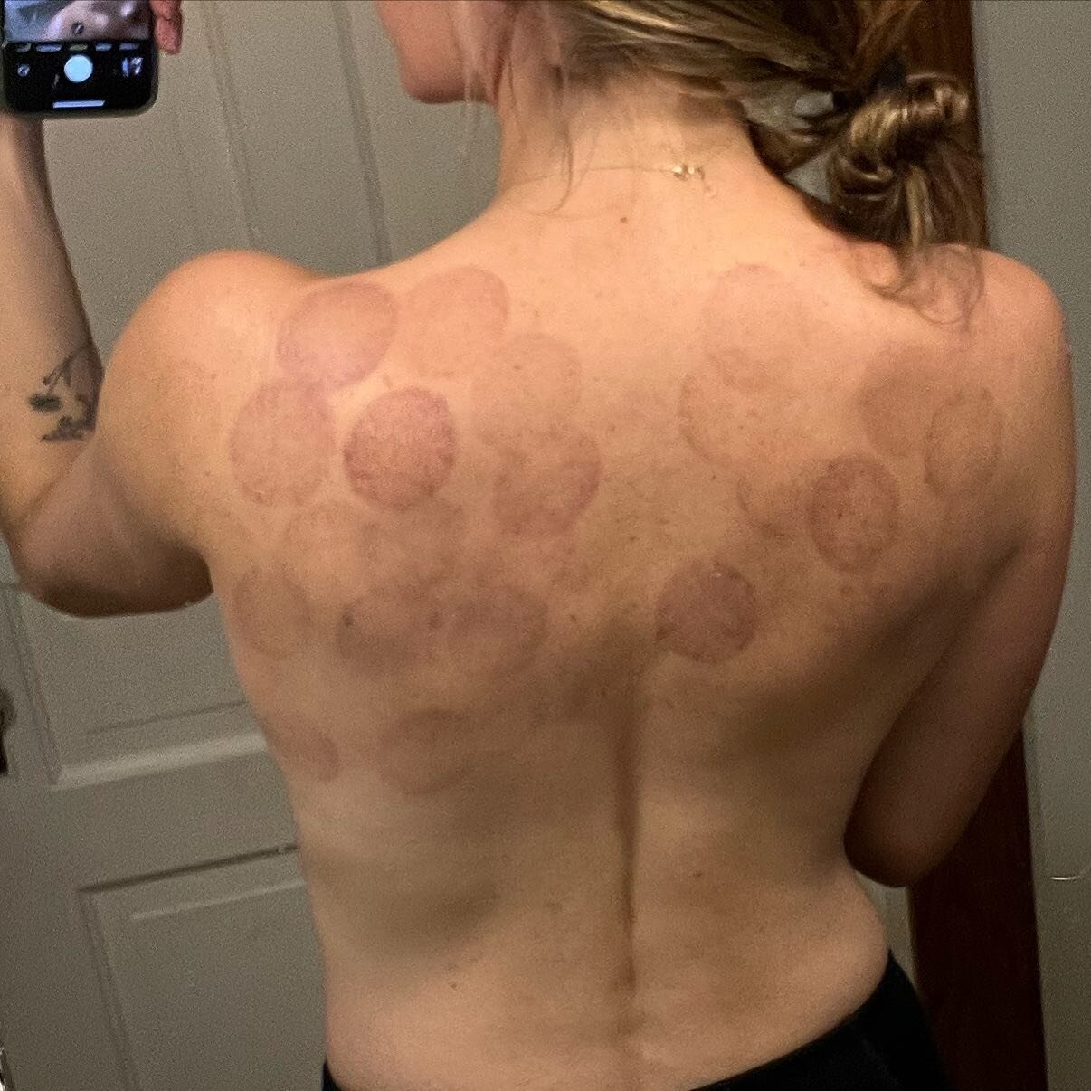 Let&rsquo;s talk about cupping!!🐙

Cupping therapy benefits:
⚡️improves blood flow-&gt; healthy skin and faster healing
⚡️pain relief
⚡️muscle relaxation and recovery
⚡️lymphatic drainage 
⚡️enhances the immune system
⚡️moves stagnant blood and Qi
⚡