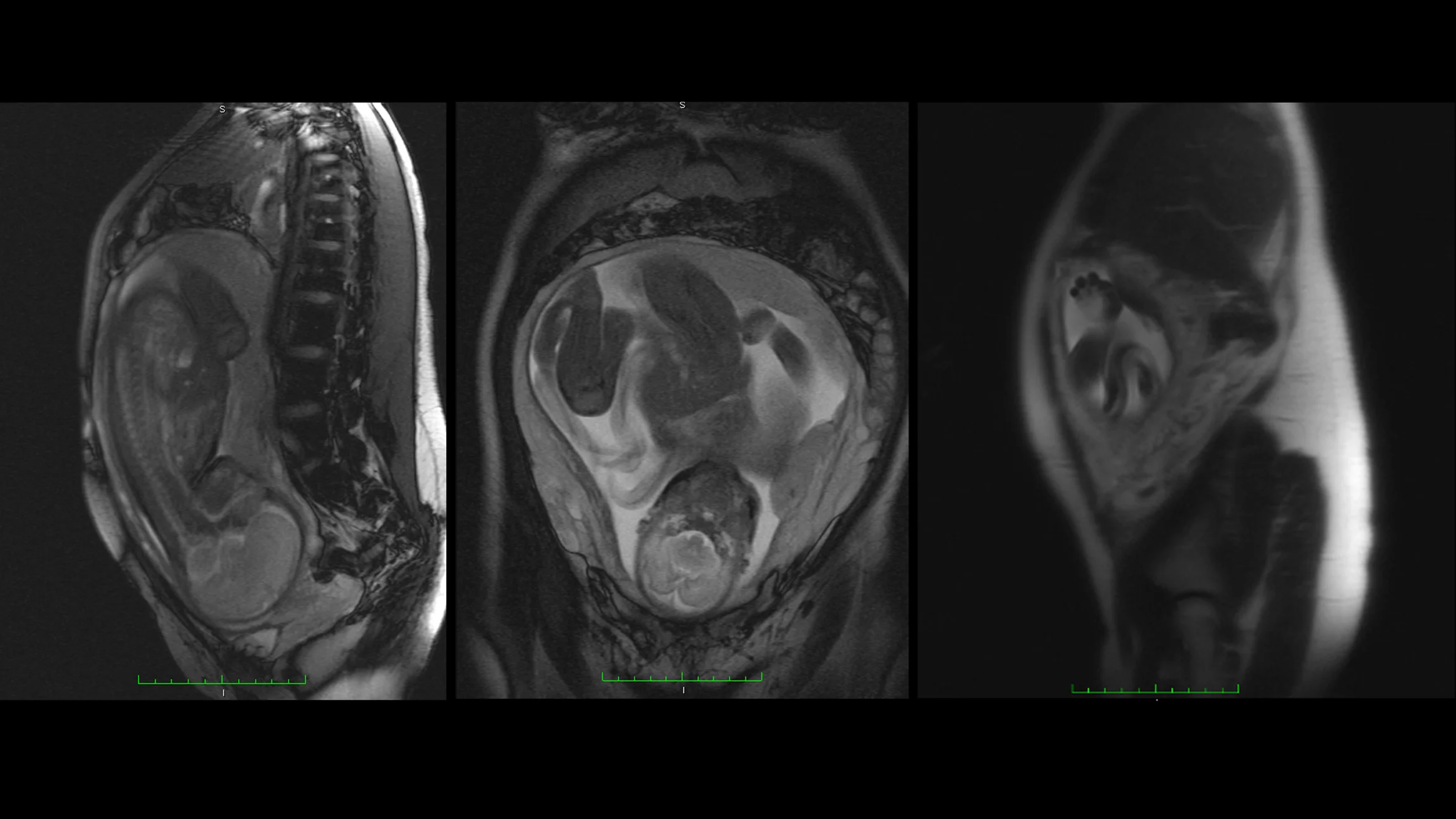 Marlia MRI