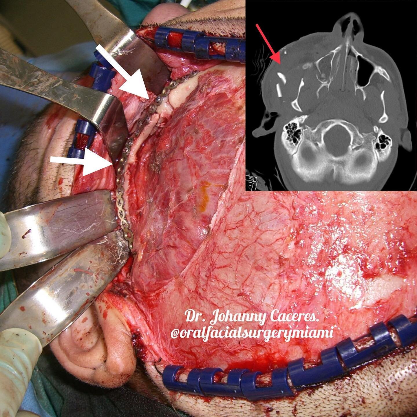 Open reduction internal fixation of a comminuted fracture of the left zygomatic arch via coronal approach. This patient was involved in a car accident and suffered panfacial fractures. 
Adequate reduction and fixation of the arch is very important to