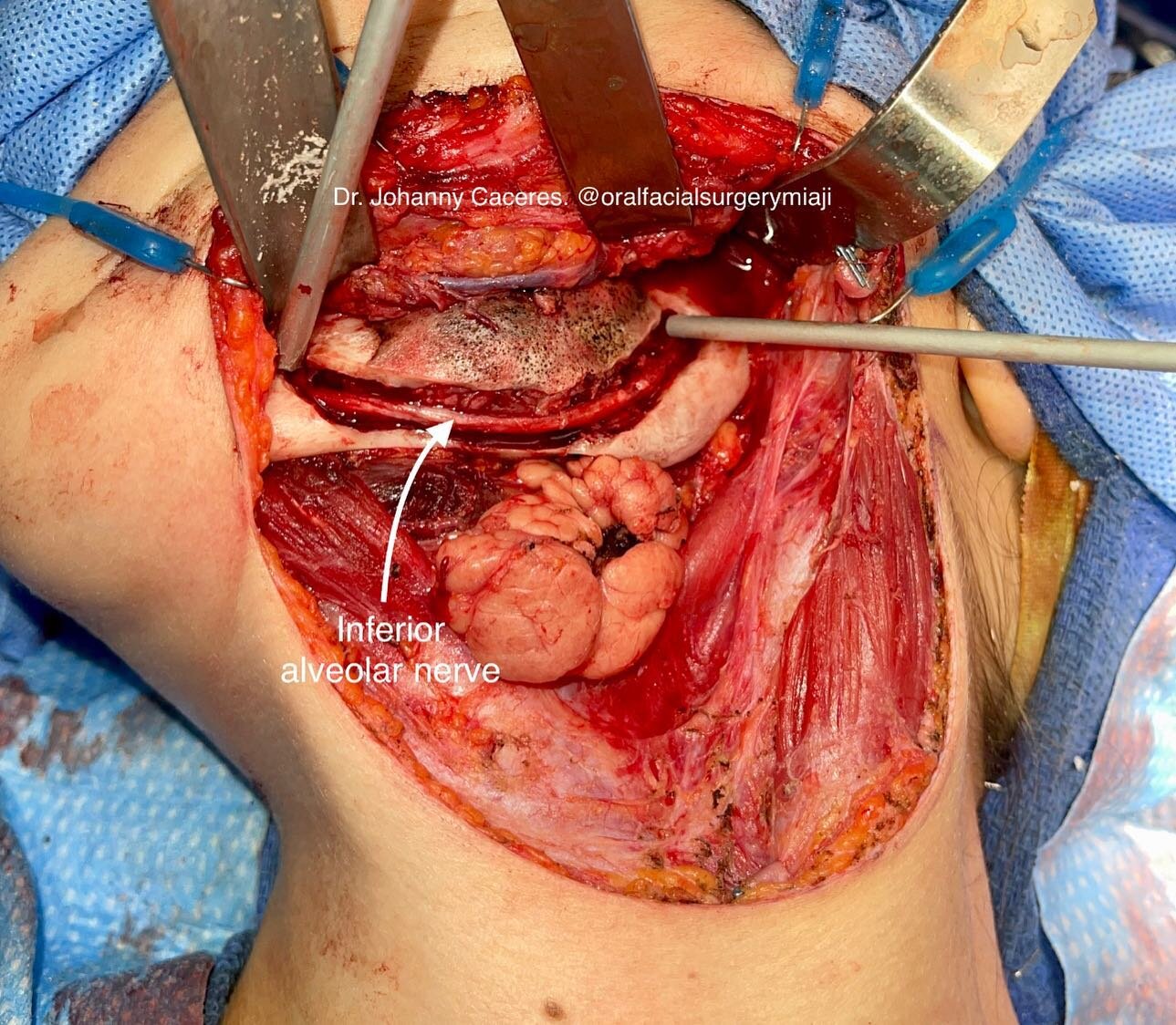 Decortication (outer cortex) of the mandible to preserve the inferior alveolar nerve prior to resection to remove a tumor.
#mandibulartumor #tumormandible #mandibulectomy #facialreconstruction #facialcosmeticsurgery #jawsurgery #orthognaticsurgery #j