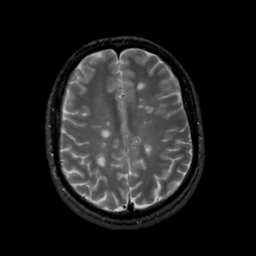 MS Brain Lesions2.jpg