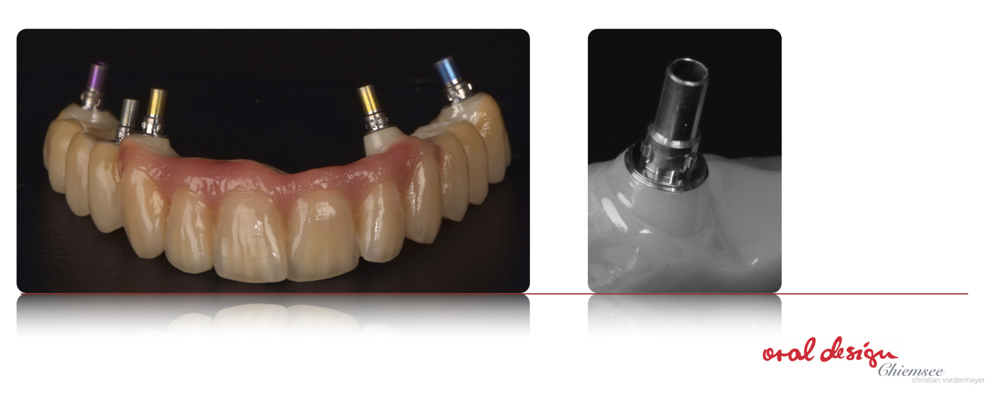 Implantatbru¦êcke.jpg