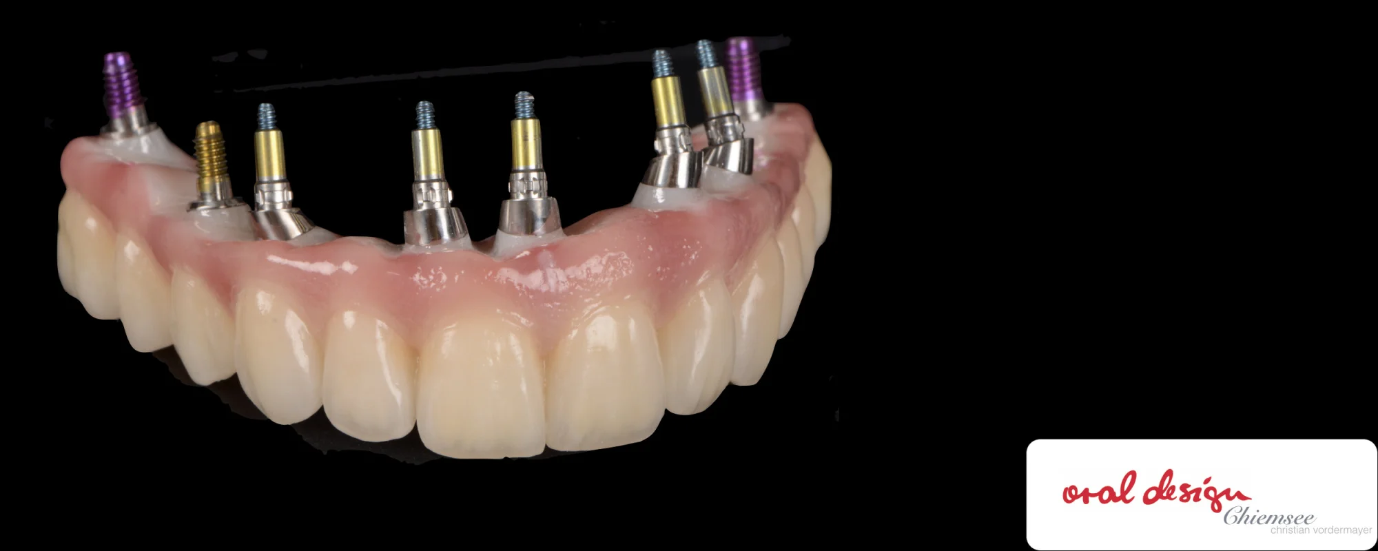 Implantatbru¦êcke5.jpg