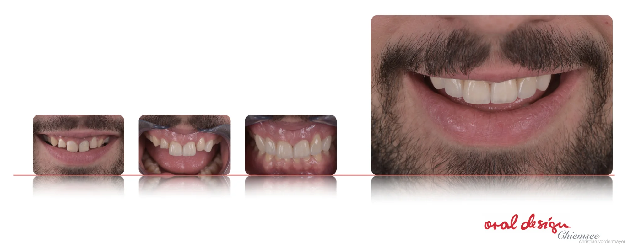 Veneers3.jpg