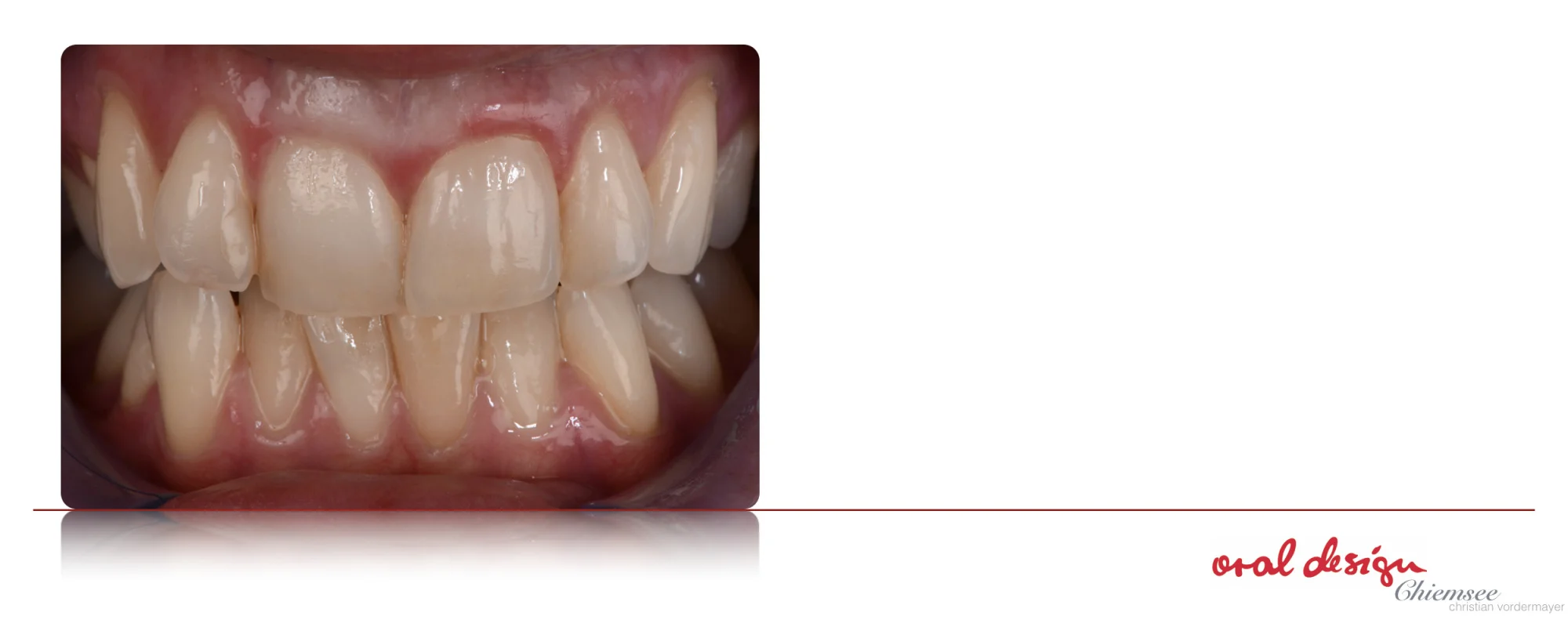Veneers5.jpg