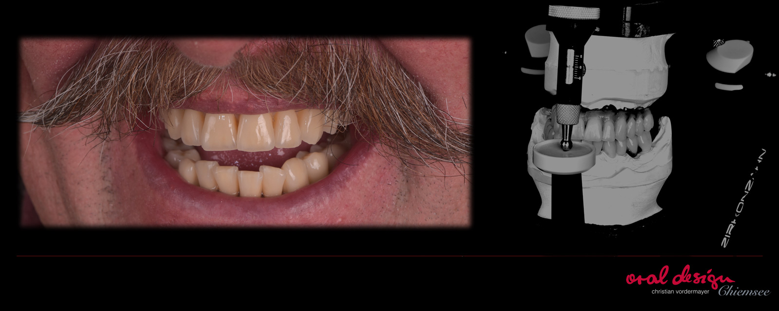 implantatprothetik-oraldesign-chiemsee-223.jpg