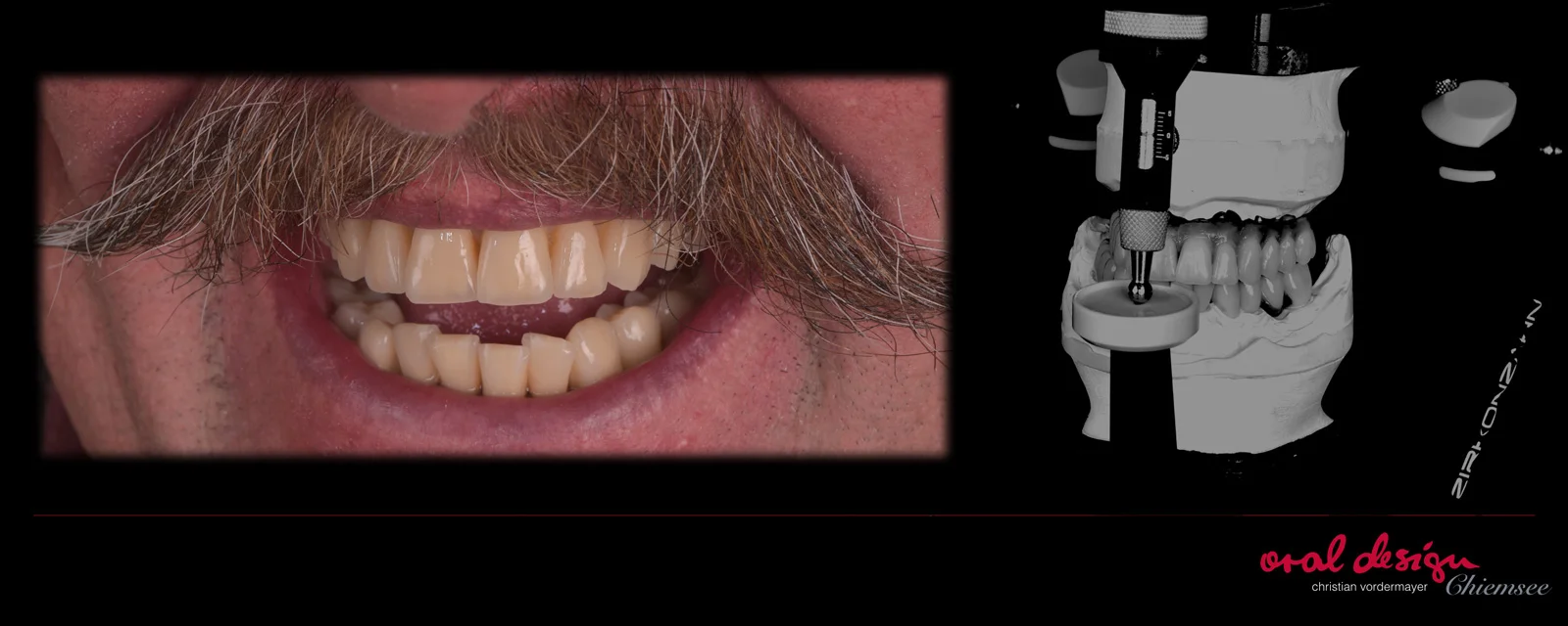 implantatprothetik-oraldesign-chiemsee-223.jpg