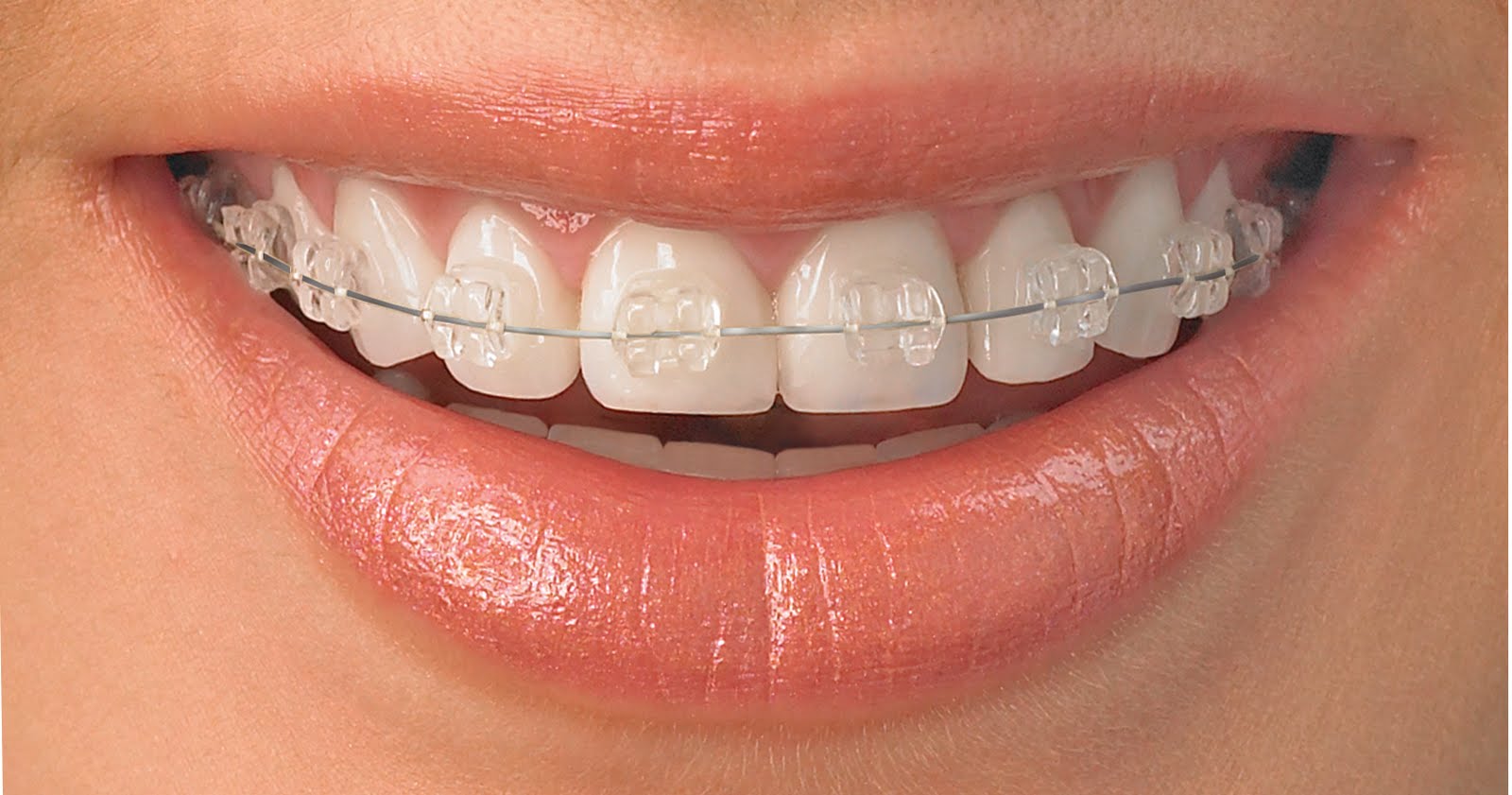 Clear-Orthodontic-Brackets1.jpg