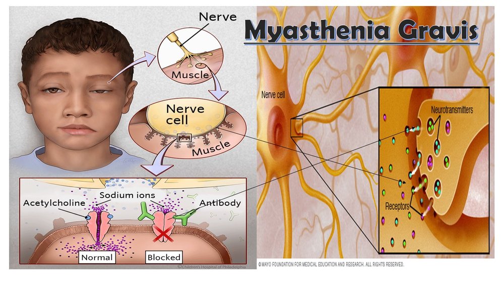 myesthnia 2.jpg