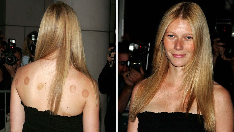 Gwyneth Paltrow after cupping treatment