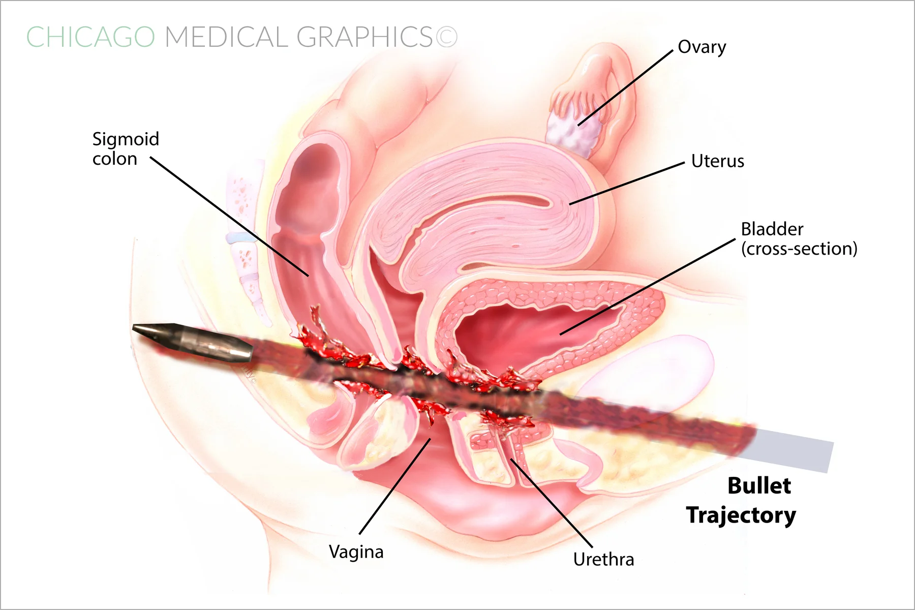 Lateral View- Bullet Trajectory