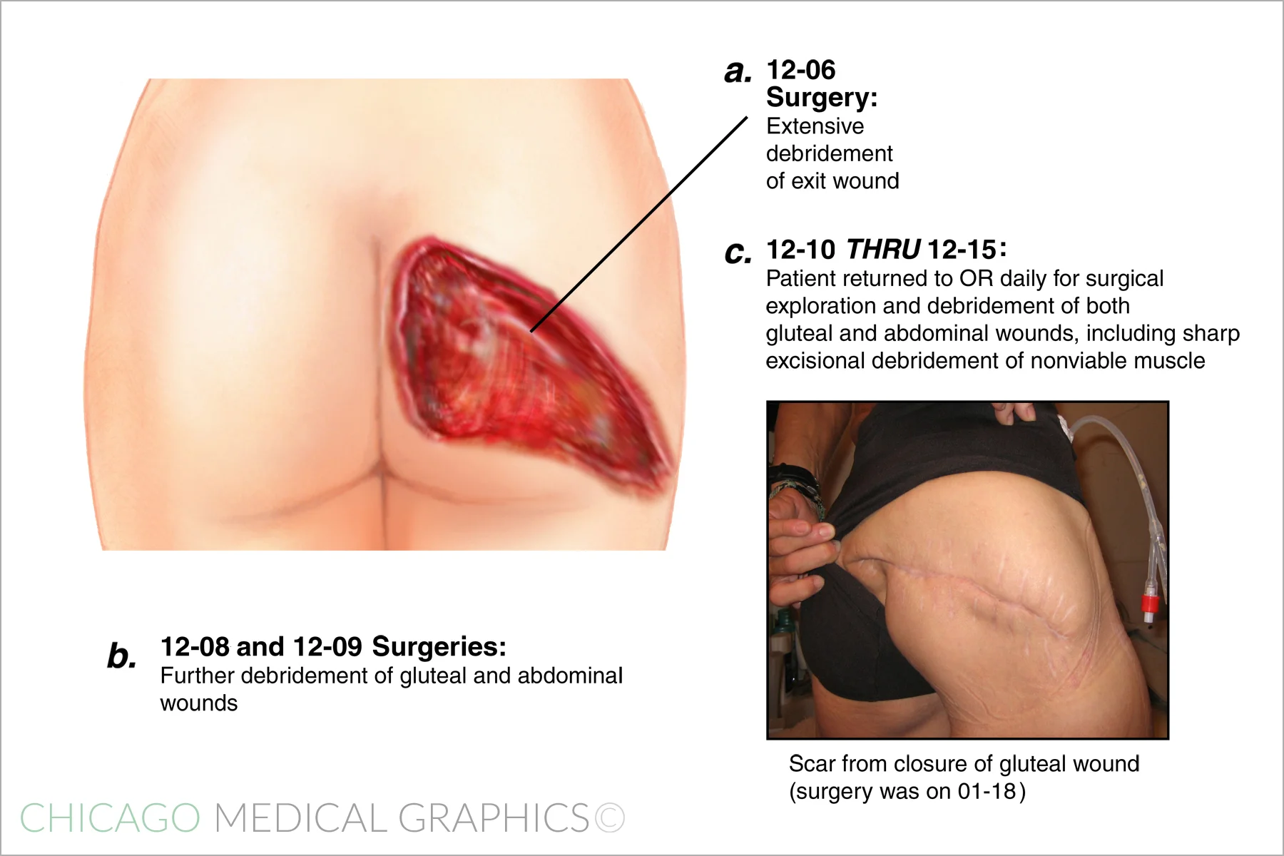Exit Wound