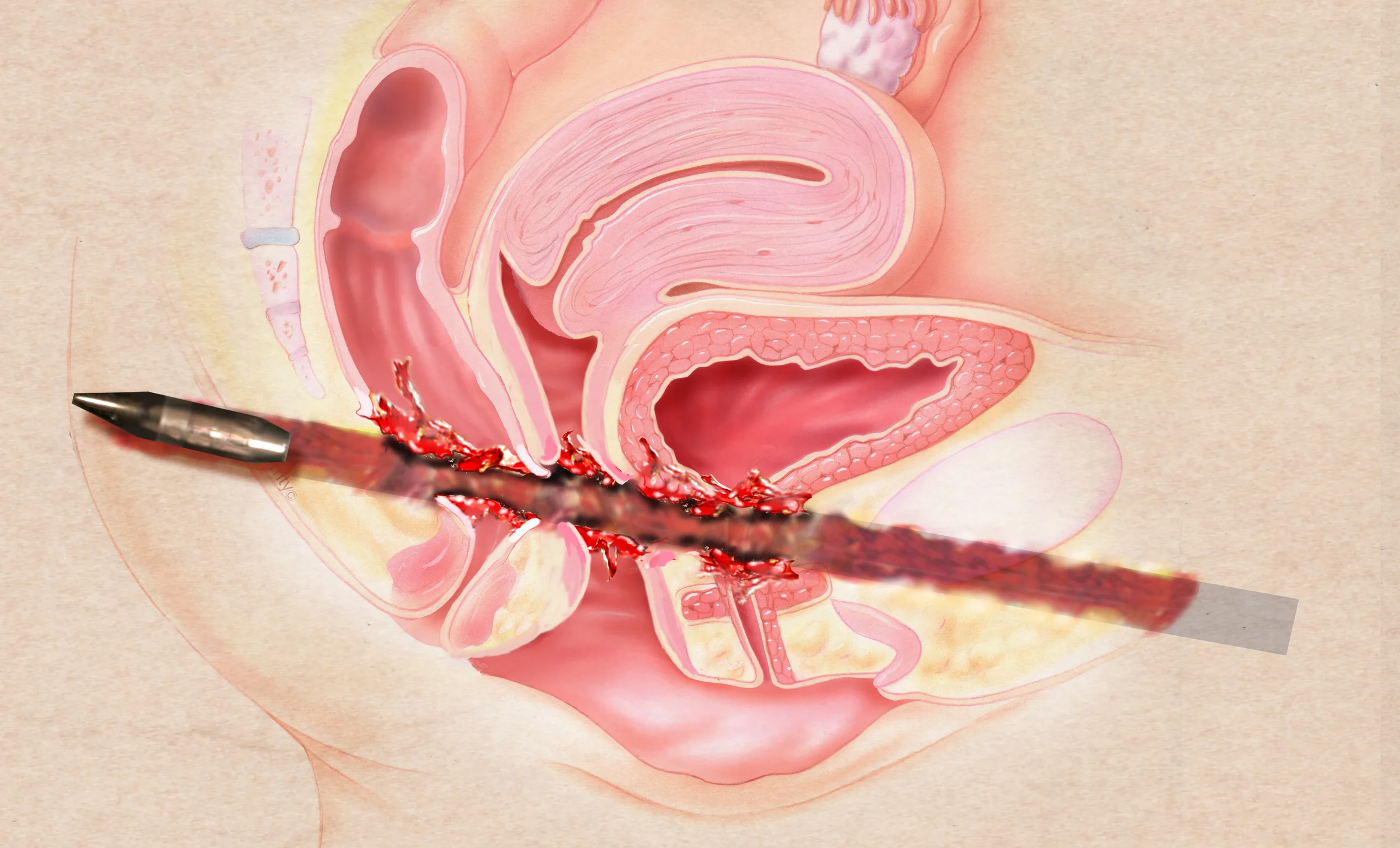 bullet pelvis.jpg