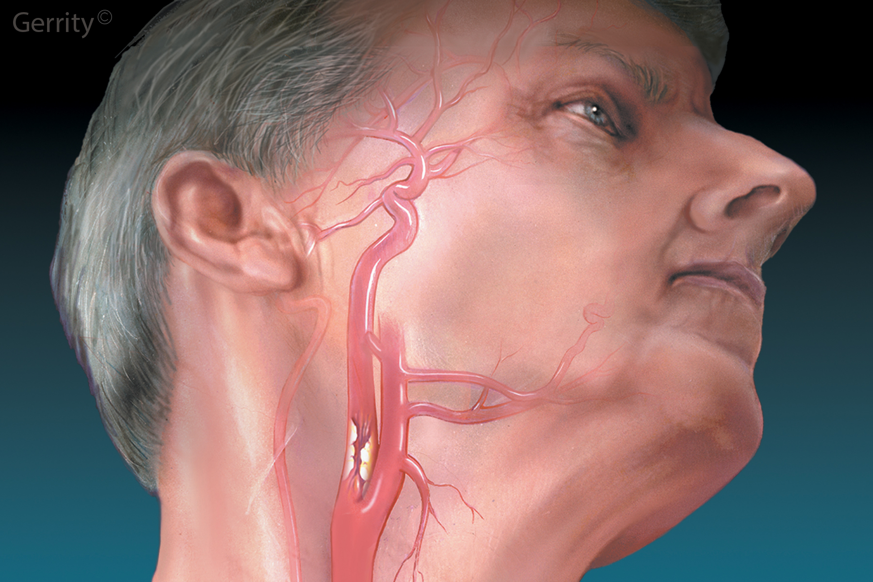 Сонные артерии на шее человека фото. Пульсация сонных артерий пляска каротид. Набухание сонных артерий.