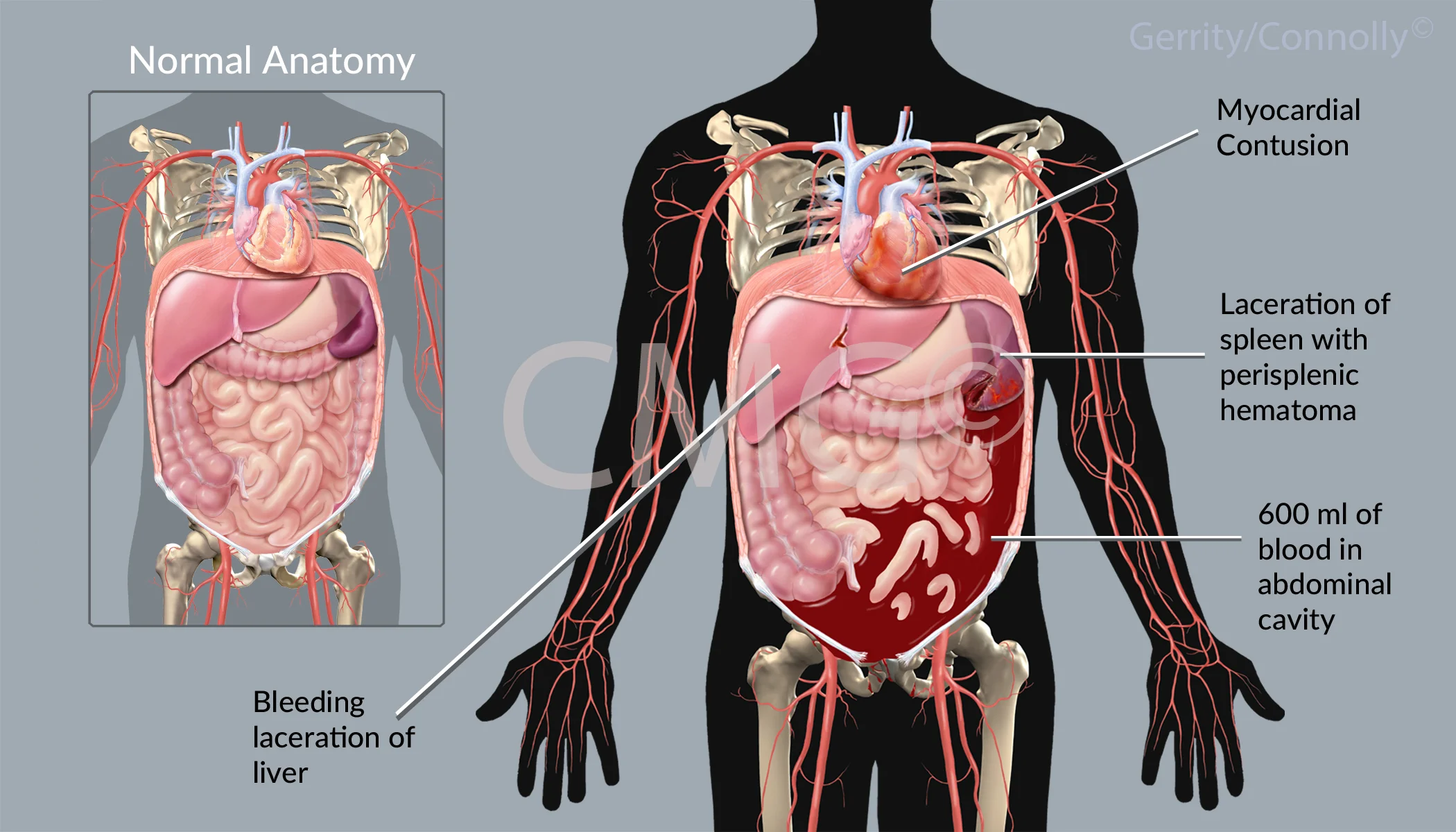 Soft Tissue Injuries
