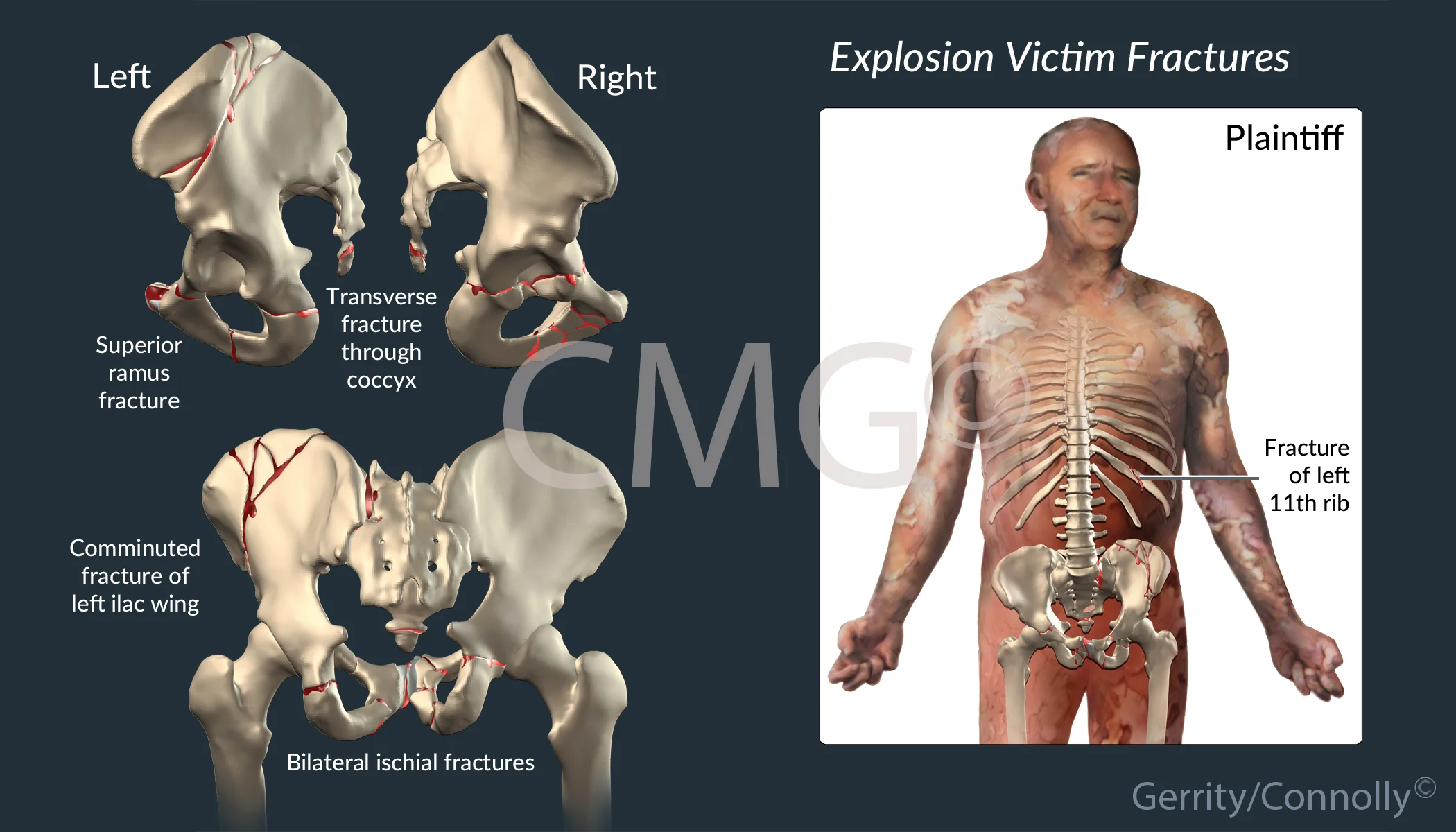 Explosion Fractures
