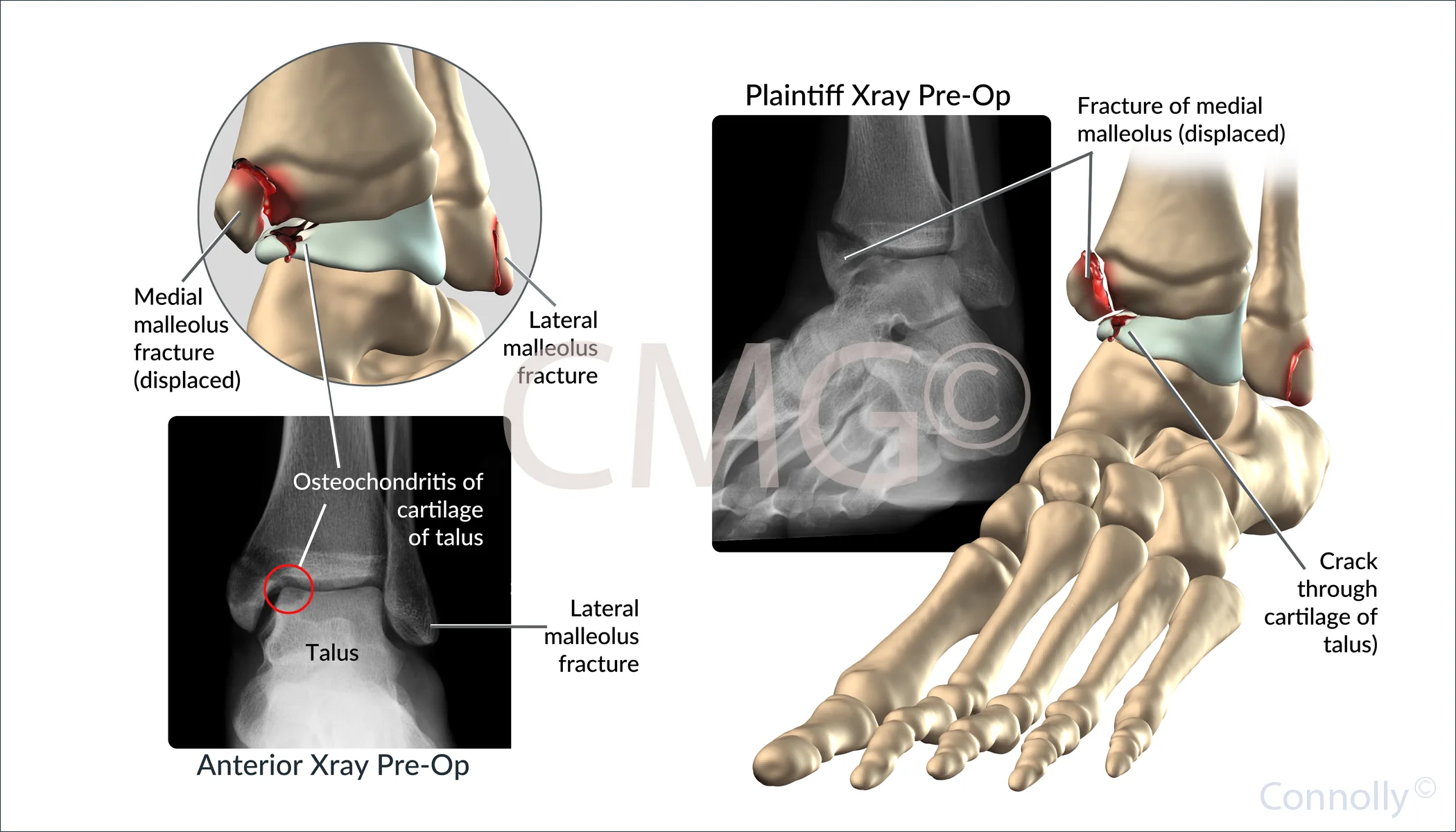 Ankle Fractures