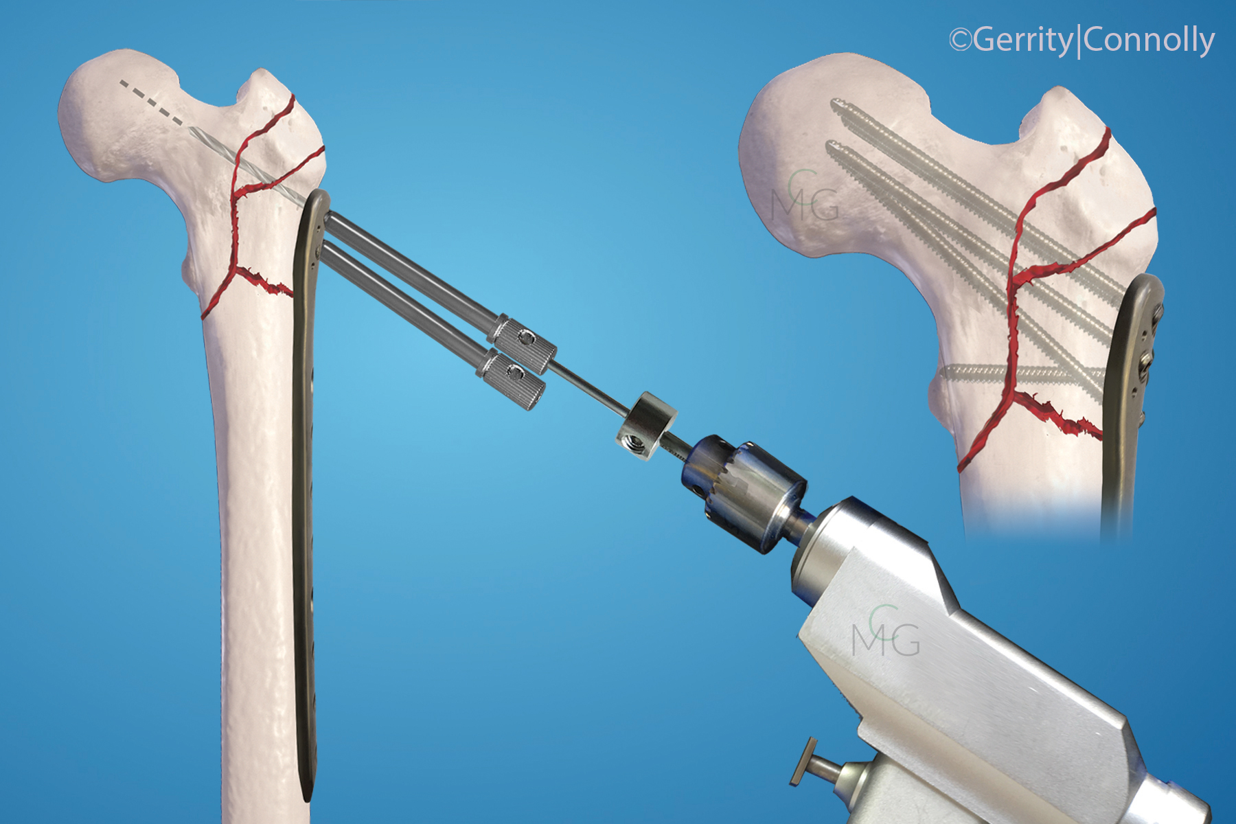 Proximal Femur