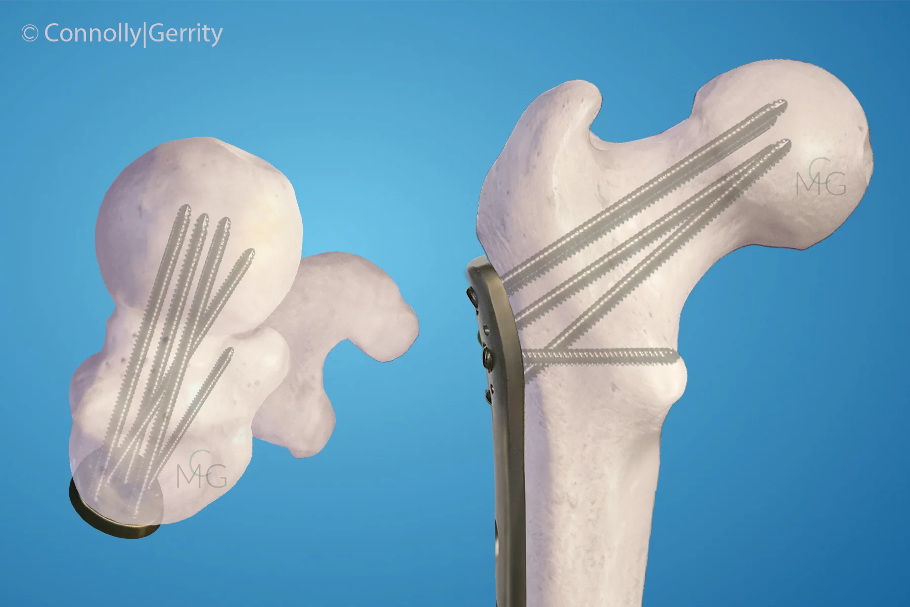 Proximal Femur